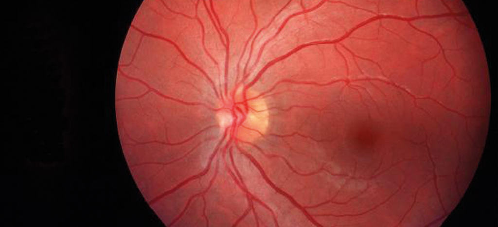 retinografía pruebas diagnósticas