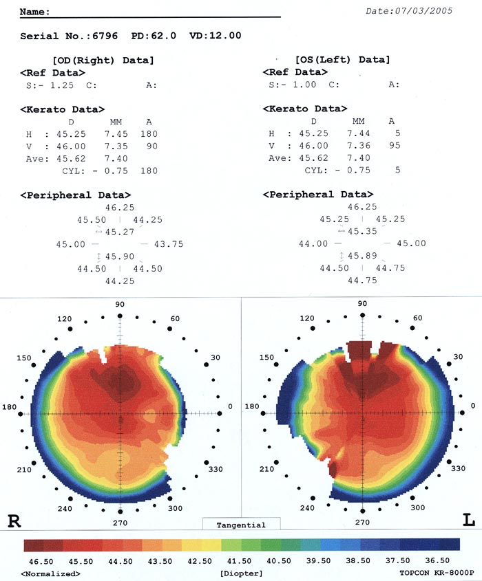 topografía corneal pruebas diagnósticas