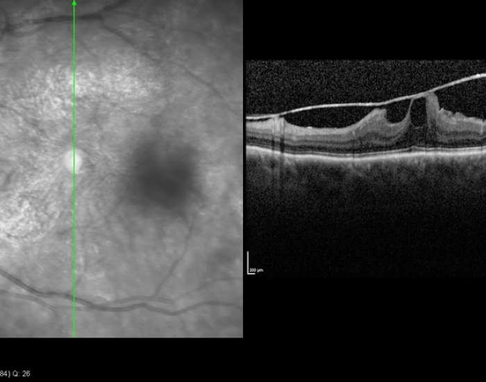 membrana epirretiniana síntomas y tratamiento