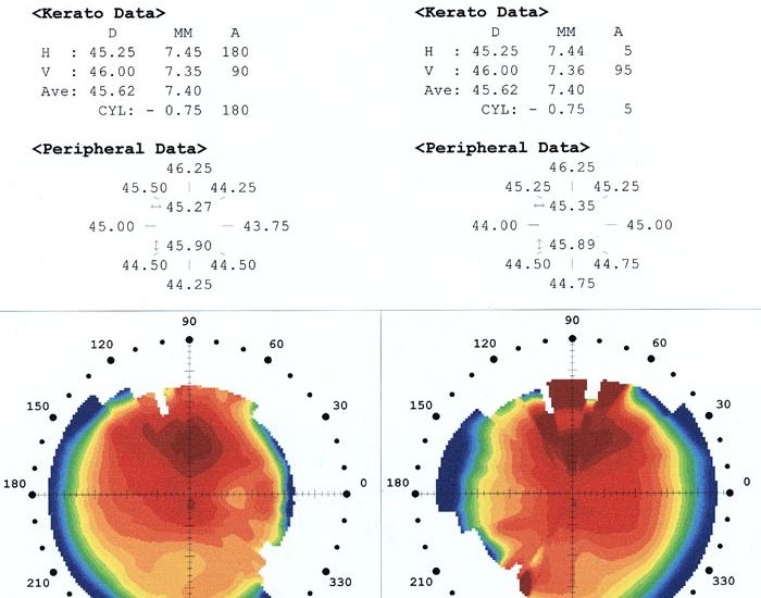 topografía corneal pruebas diagnósticas